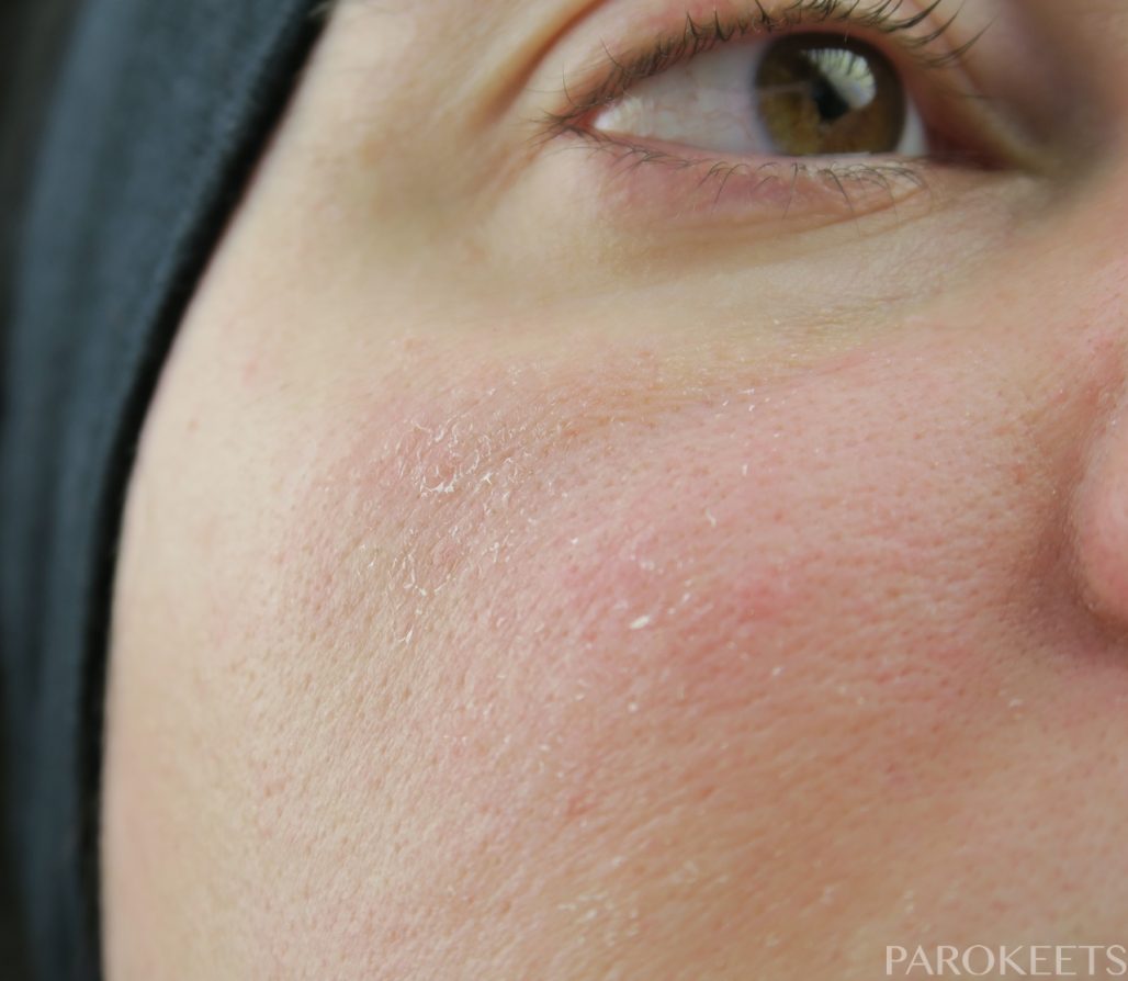 Boj proti luskasti koži - pred nanosom by Gabi Gejba Parokeets
