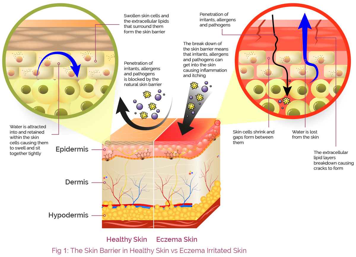 Kožna bariera pri normalni koži vs. dermatitis koži by Aproderm.com